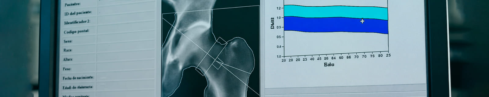 Densitometría Ósea